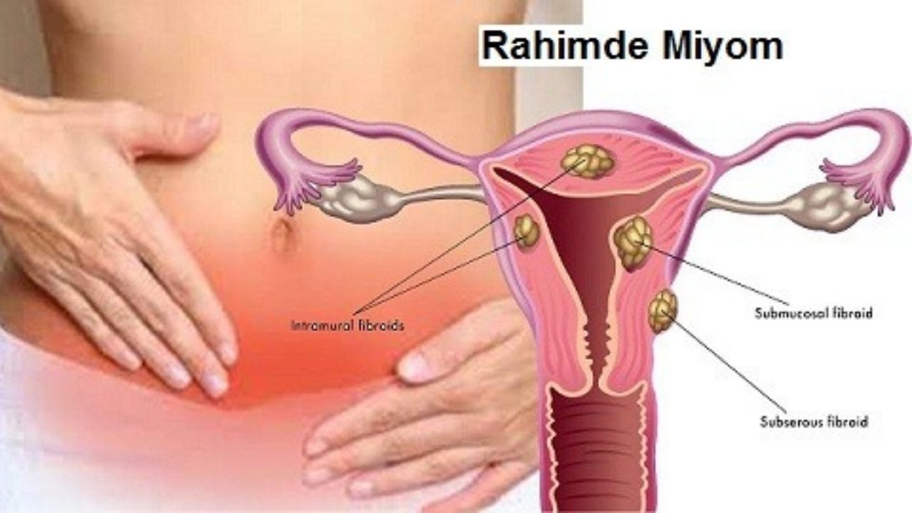 Rahim Miyomları Nedir, Belirtileri Nelerdir? Tedavisi Nasıl Yapılır?